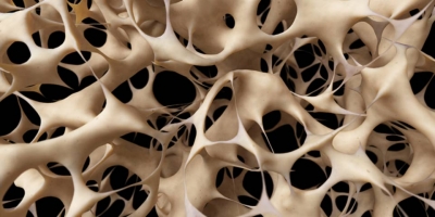 osteoporosi